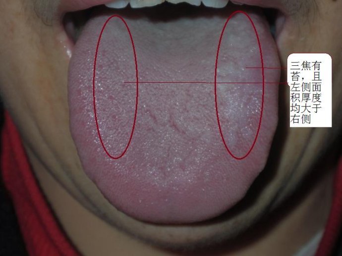 舌苔,是舌体上附着的一层苔状物,有胃气所生.