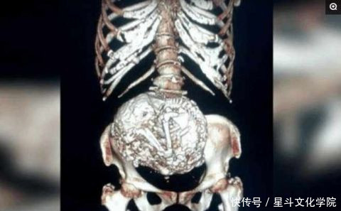 90岁老人被查出怀孕,腹中胎儿竟然也有60多岁