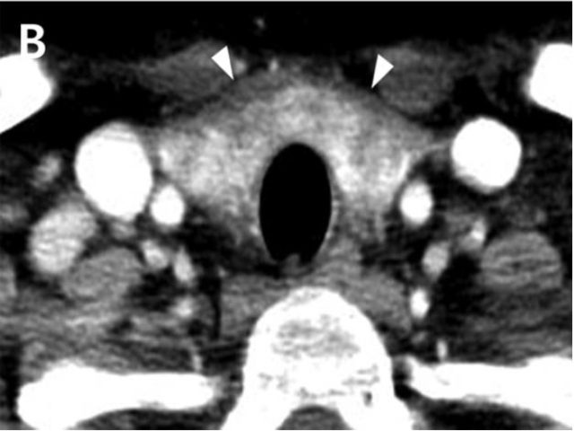 类似于「亚急性甲状腺炎」的「淀粉样甲状腺肿」