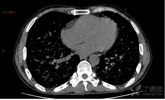 双肺弥漫性铺路石征，你考虑什么?