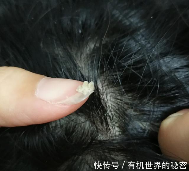 头皮油能抠下灰泥,说明几万螨虫扎根毛孔,再不