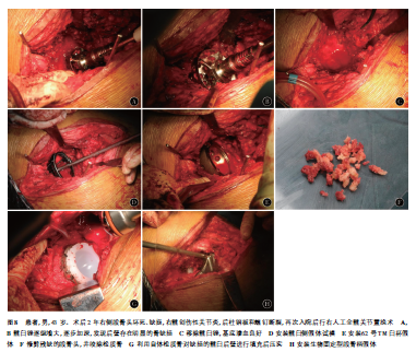 髋臼骨折晚期人工全髋关节置换的难点