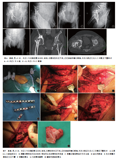 髋臼骨折晚期人工全髋关节置换的难点