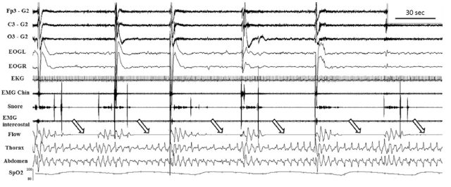 一觉醒来出现偏瘫,患者到底怎么了?
