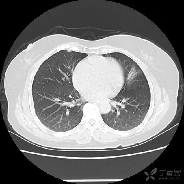 分叶+毛刺+GGO=肺腺癌?NO!