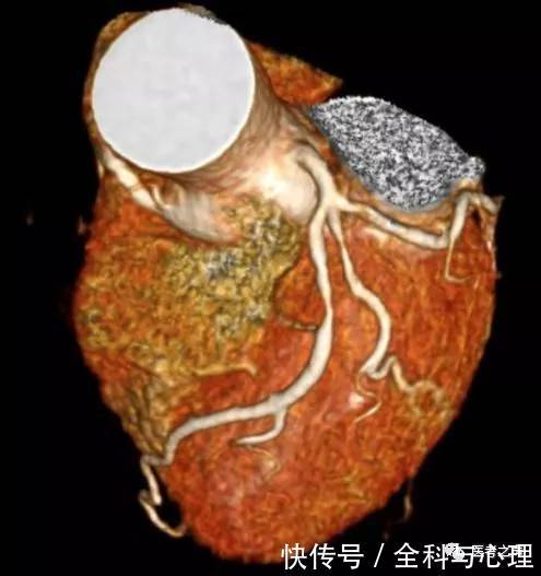 稳定型心绞痛? 到底是什么稳定?