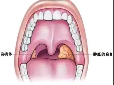 山西耳鼻喉|扁桃体炎:不可忽视的小病