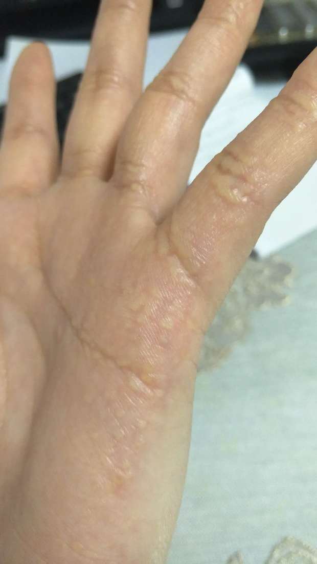 手掌长满了硬疙瘩 不痛不痒 不是水泡_360问答