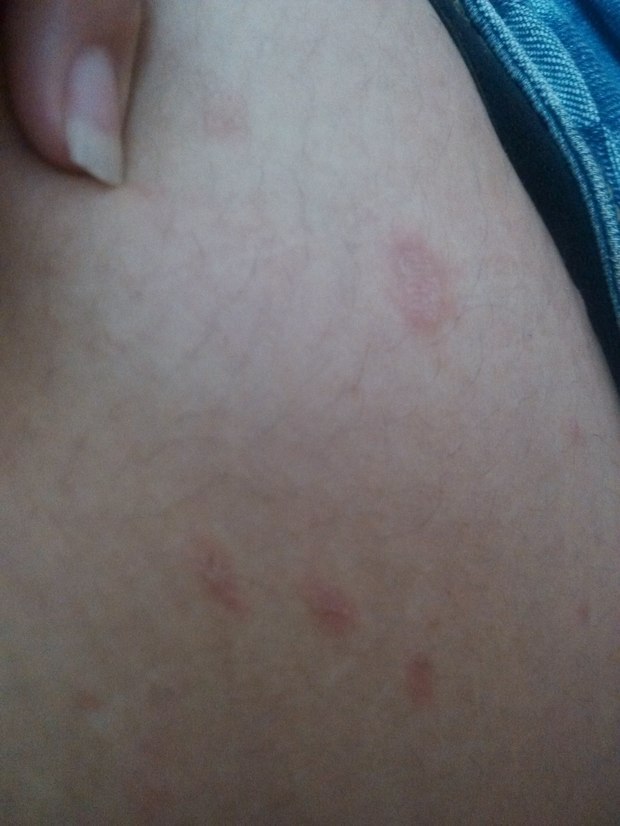 身上张了些小红斑 有时会痒 还脱皮