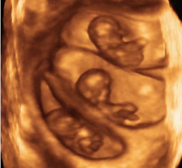孕妇怀孕4个月肚子竟像7个月大,去医院检查后