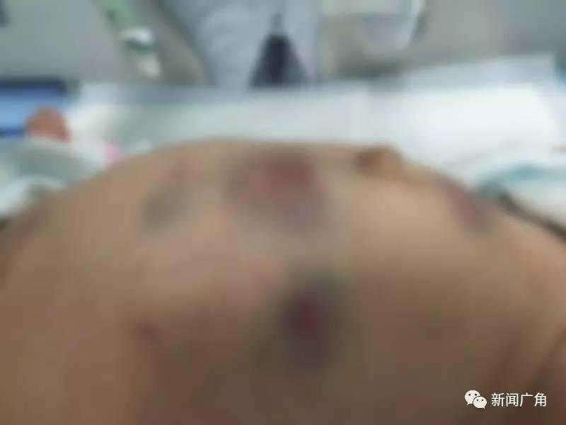 【转】北京时间 外婆信土方找人放血 男婴被扎30多针 - 妙康居士 - 妙康居士~晴樵雪读的博客 【转】北京时间 外婆信土方找人放血 男婴被扎30多针 - 妙康居士 - 妙康居士~晴樵雪读的博客