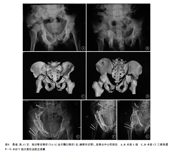 髋臼骨折晚期人工全髋关节置换的难点