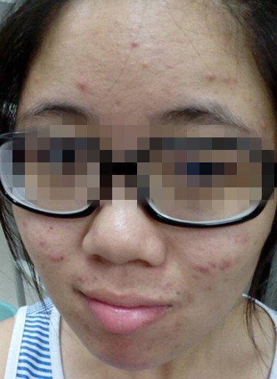 成人女性脸上长痘痘 是什么原因引起的_360问
