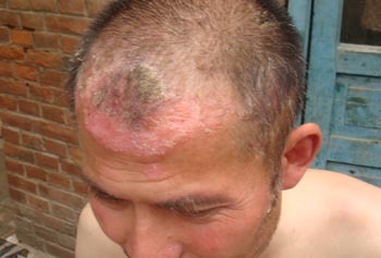 西医称为银屑病(psoriasis),俗称牛皮癣,其特征是出现大小不等的丘疹