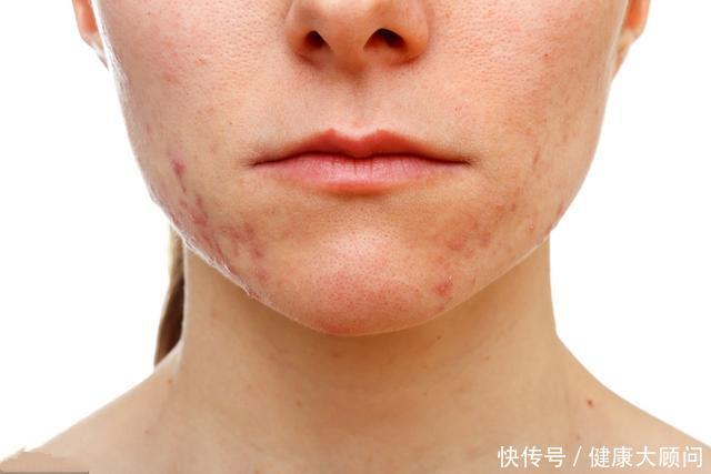 吃再多药,不如来杯蒲公英水,这5类人喝,功效