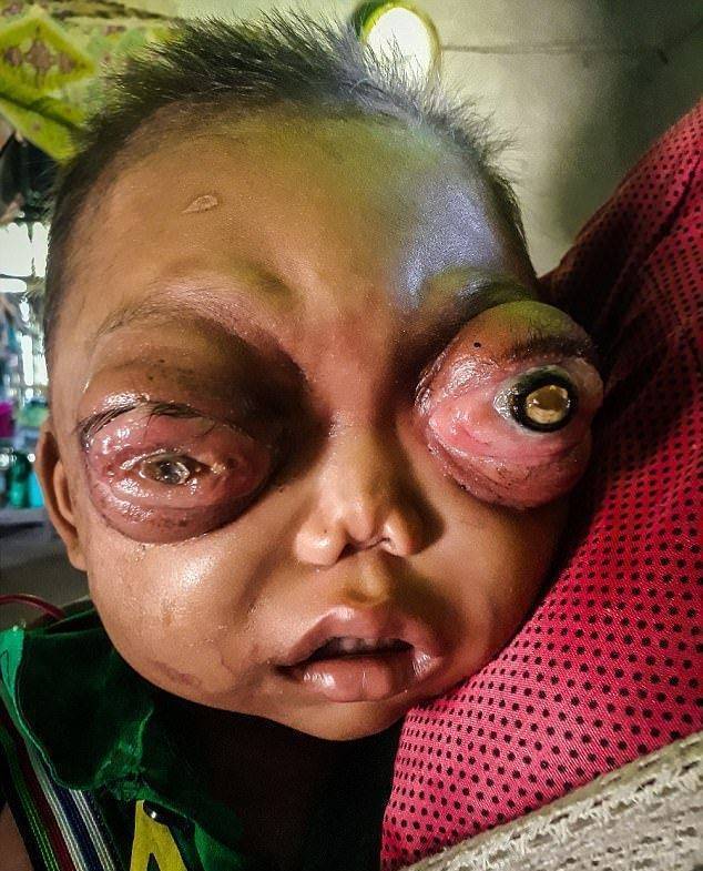 2岁童患罕病眼睛肿大到快掉出,正渐渐失去视力!