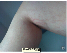 乳房上面和腿上爬满了这样 一条条的血管鼓出来是怎么