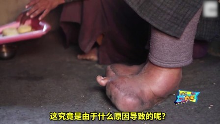 半岛奇闻 印度女孩患“象皮病” 双脚长满寄生虫