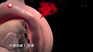 名医话养生_20210916_会撕裂的生命“拐杖”