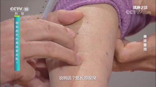 健康之路 《健康之路》 20200402 黑痣警报