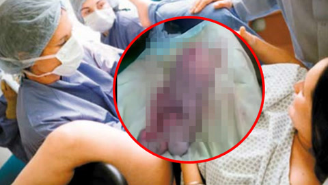 涨健识 女子腹痛竟诞下“肉灵芝”