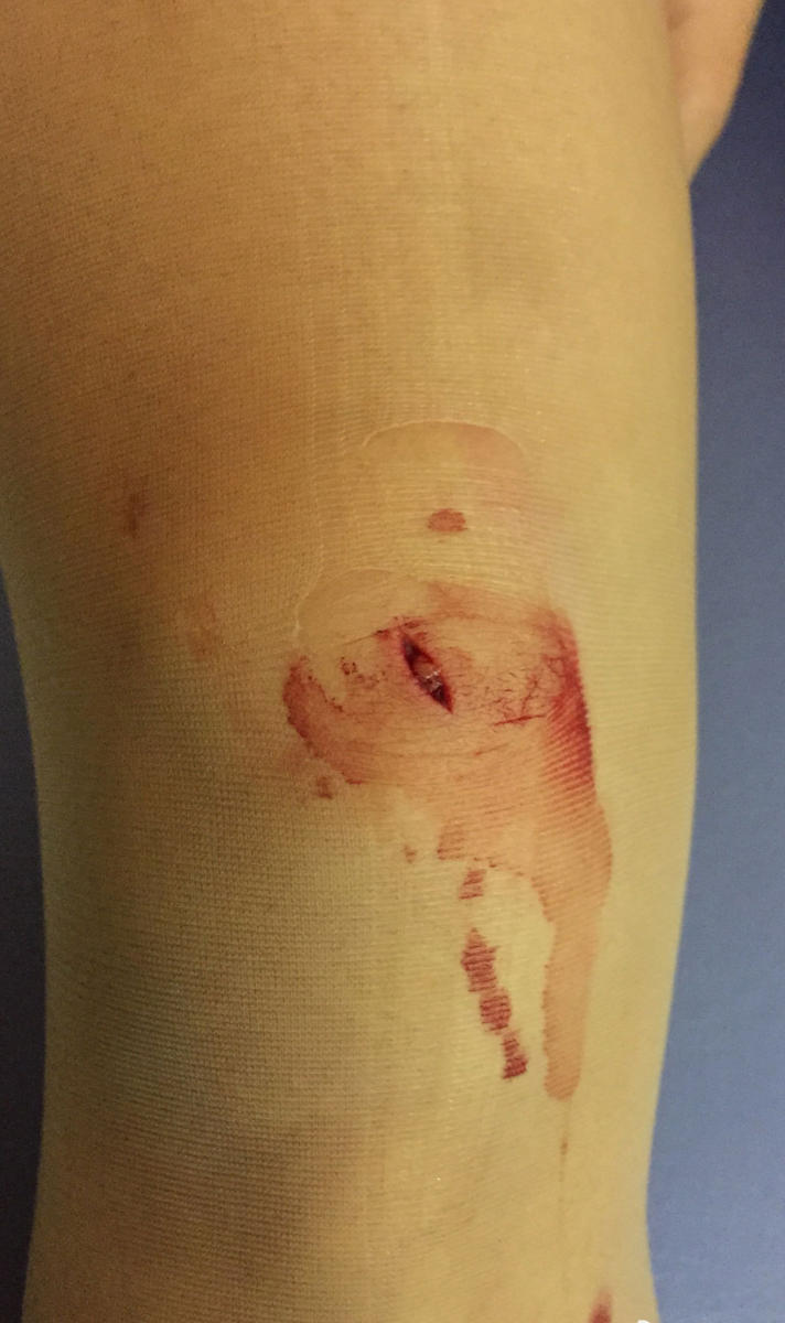 王诗玥比赛时受伤