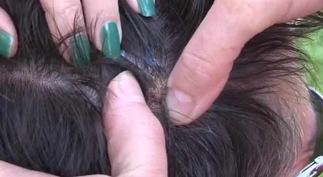 男子因头上长了个粉刺头疼,去医院剃光头检查后令医生头皮发麻