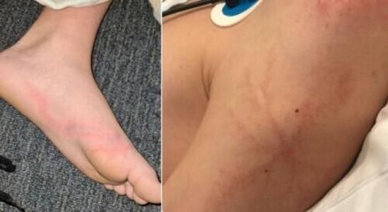 另外,雷击时产生的火花,也会造成不同程度的皮肤烧灼伤.