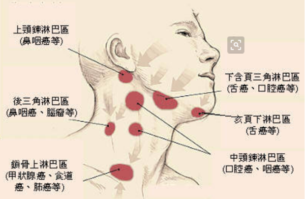 包括原發於淋巴結的惡性腫瘤如淋巴瘤,淋巴細胞性白血病和惡性組織