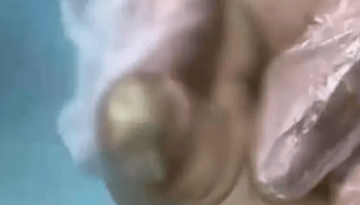 8岁男孩泡温泉感染HPV